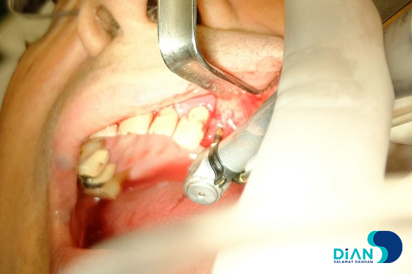 Implantation in Molar