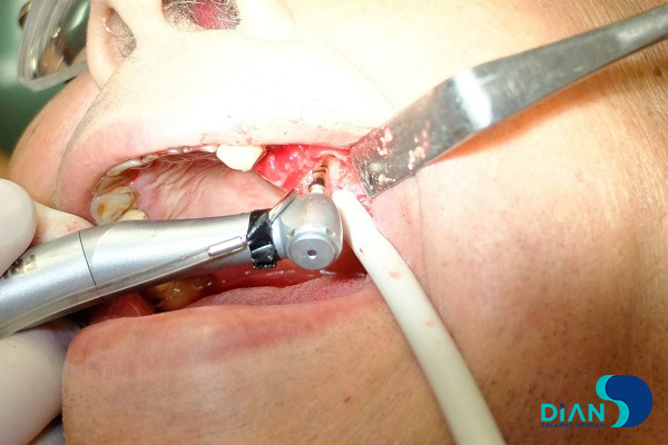 Implantation in Molar