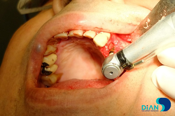 Implantation in Molar