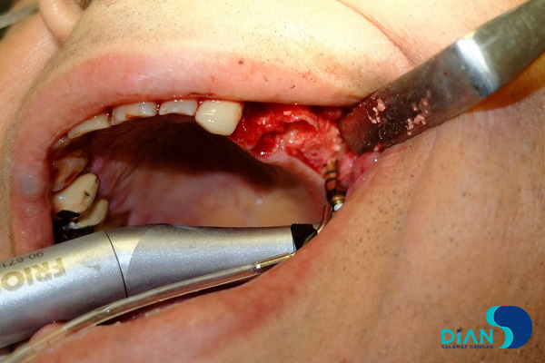 Implantation in Molar