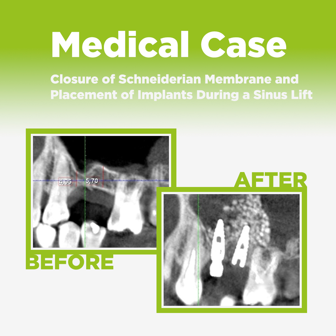 Closure of Schneiderian Membrane Perforation and Placement of Two Implants During a Sinus Lift Surgery placement bio3 implants sinus lift surgery