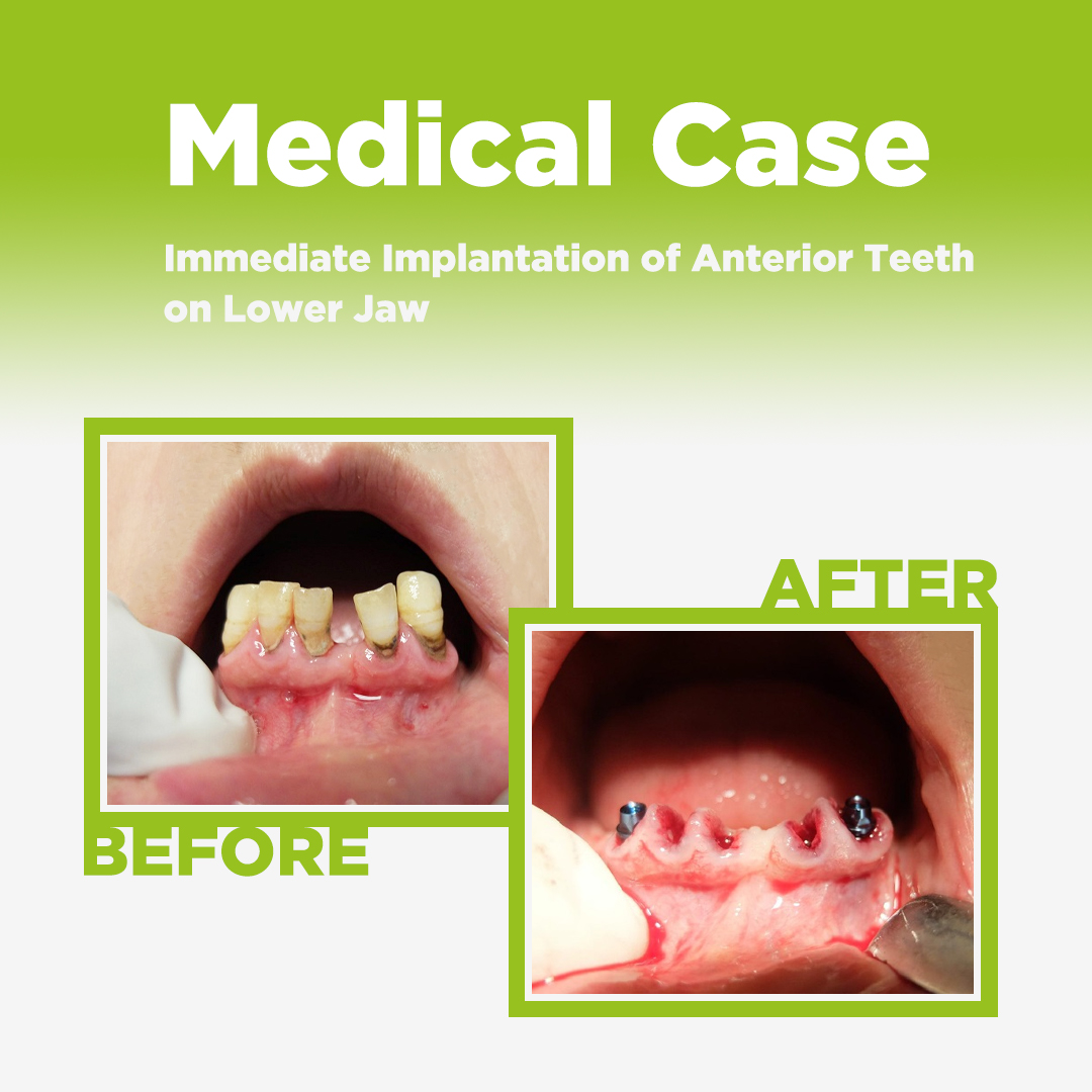 Immediate Implantation of Anterior Teeth on Lower Jaw ایمپلنت فوری