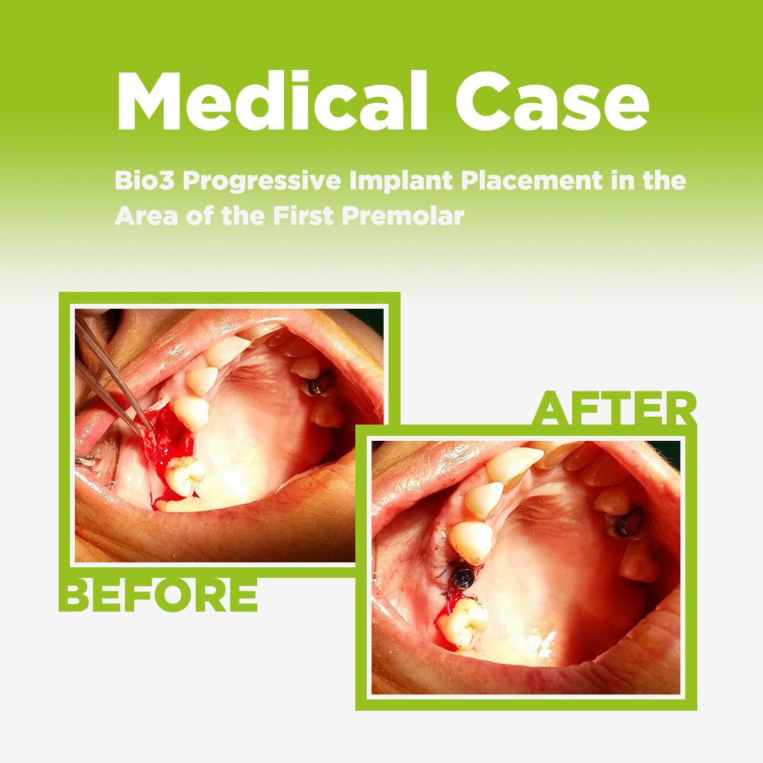 Bio3 Progressive Implant Placement in the Area of the First Premolar Bio3 Progressive Implant