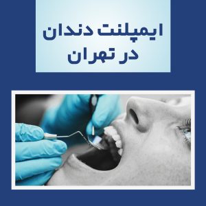 ایمپلنت دندان در تهران (طول درمان + مراحل آن) ایمپلنت دندان در تهران