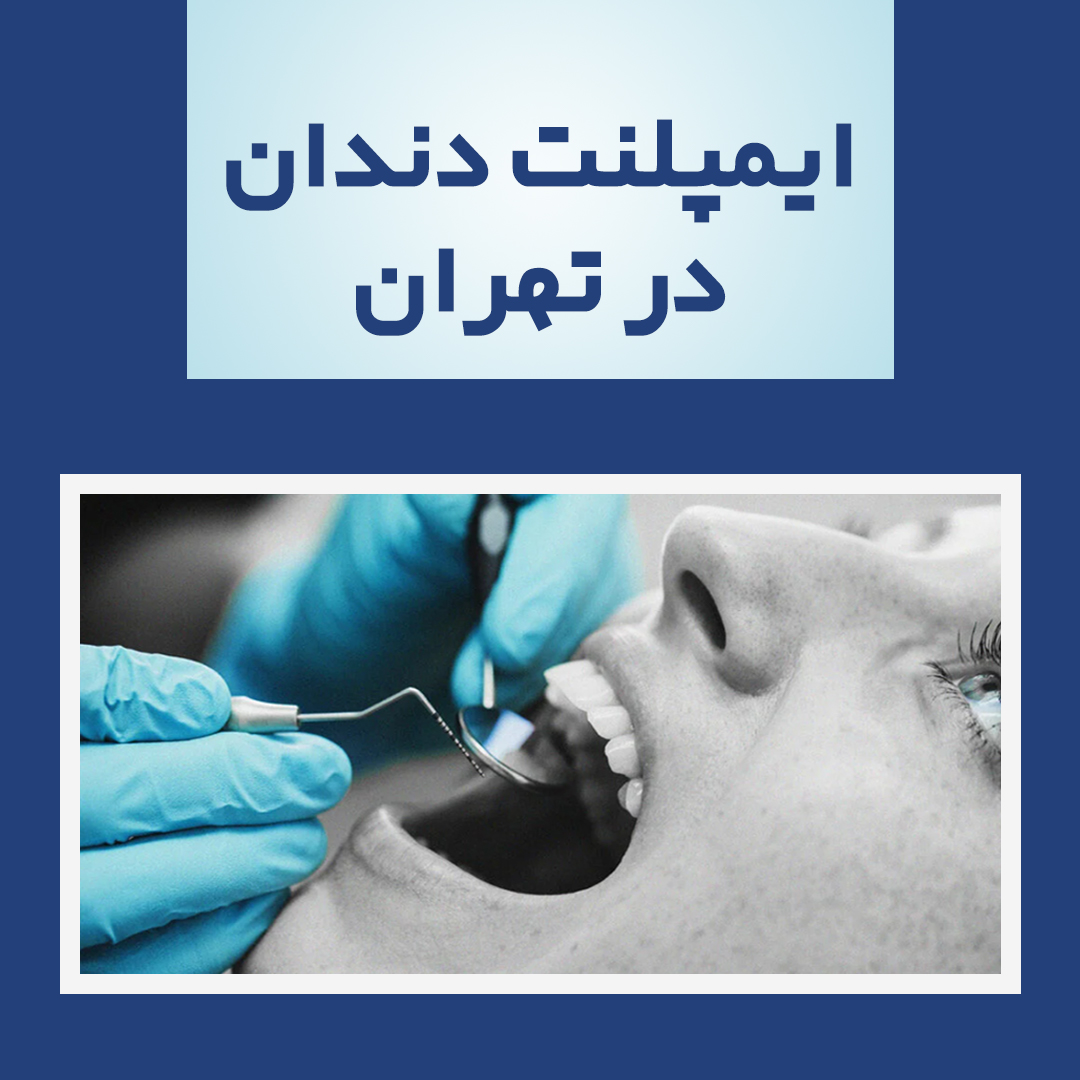 ایمپلنت دندان در تهران