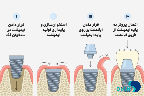 مراحل ایمپلنت دندان