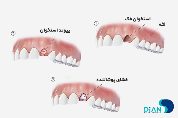 پیوند استخوان