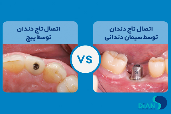سیمان یا پیچ