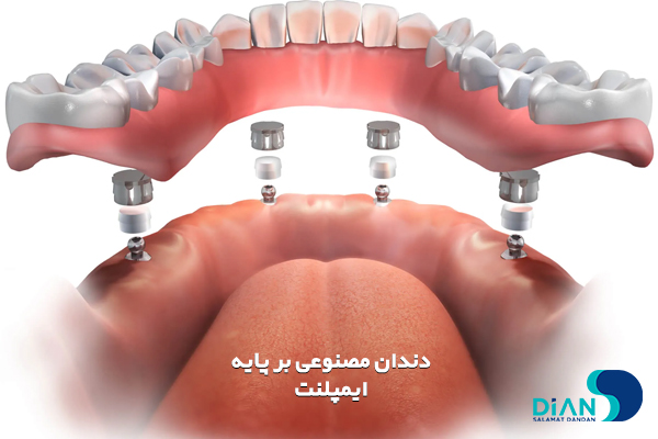 دندان مصنوعی بر پایه ایمپلنت