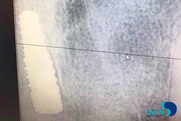 کاشت ایمپلنت دندان