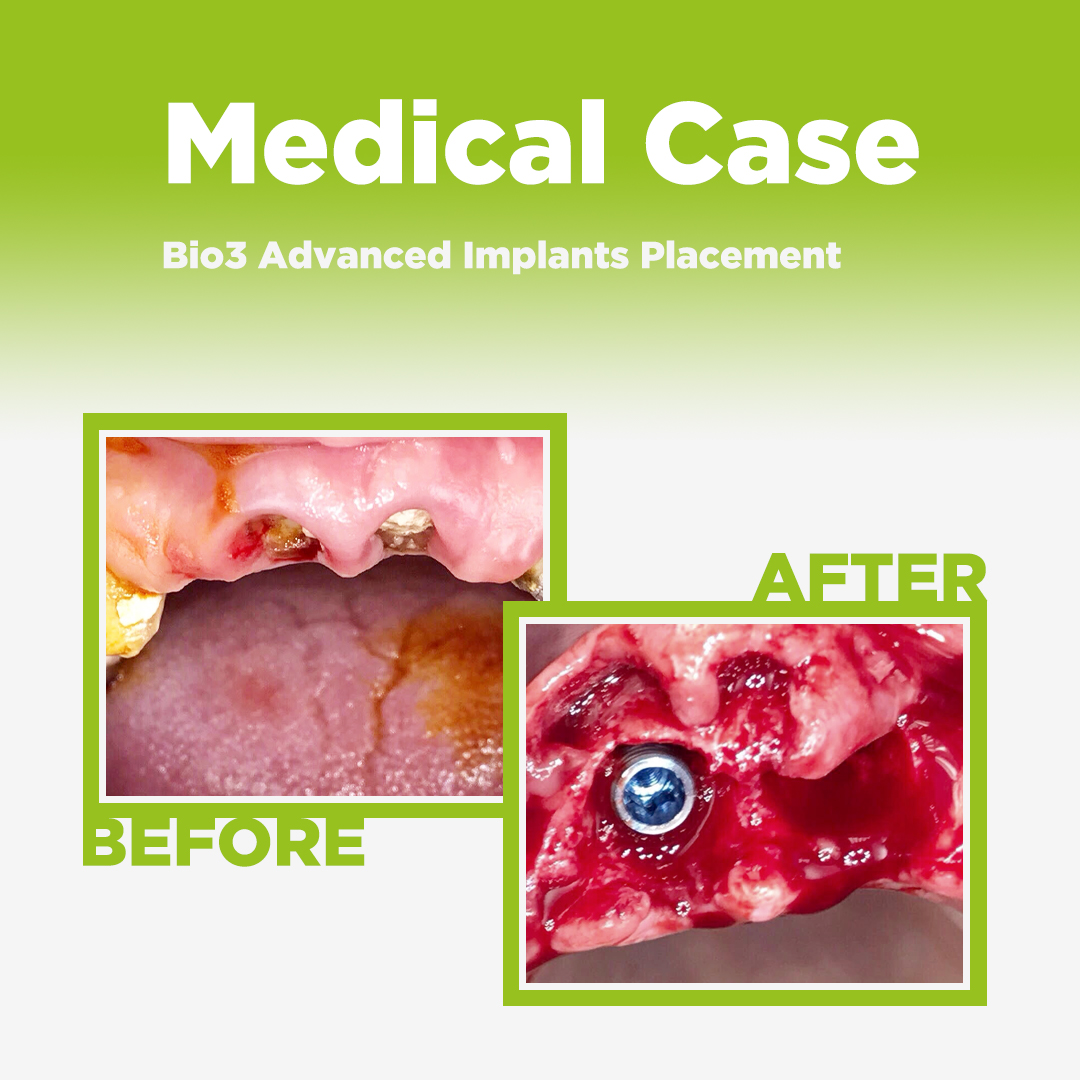 Bio3 Advanced Implants Placement کاشت ایمپلنت دندان
