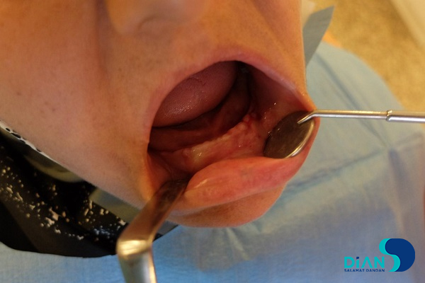 Immediate Implantation on the Lower Jaw