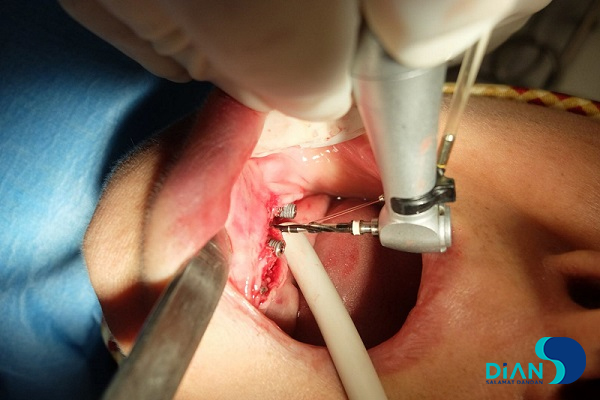 Immediate Implantation on the Lower Jaw