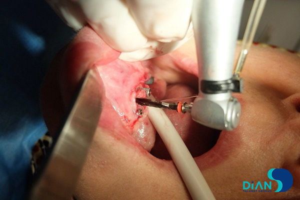 Immediate Implantation on the Lower Jaw