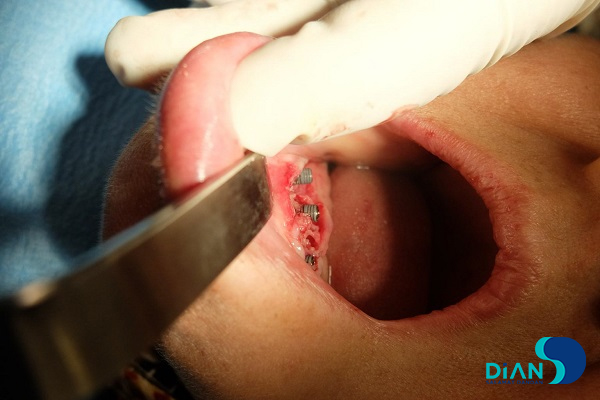 Immediate Implantation on the Lower Jaw