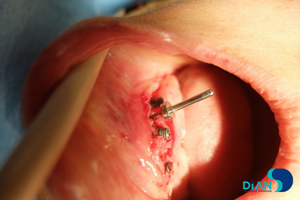 Immediate Implantation on the Lower Jaw