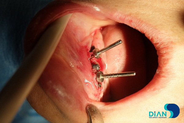 Immediate Implantation on the Lower Jaw