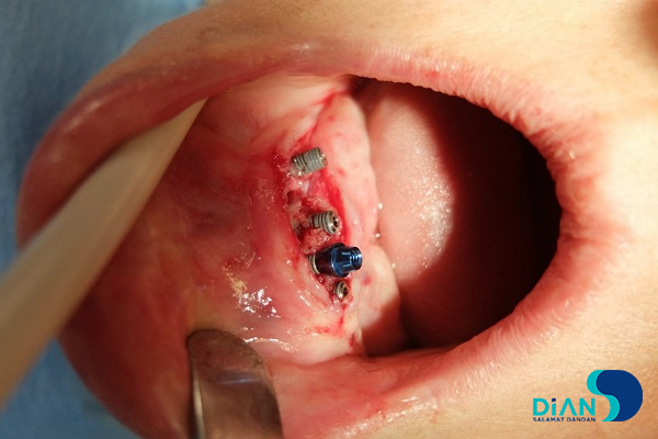 Immediate Implantation on the Lower Jaw