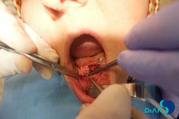 Immediate Implantation on the Lower Jaw
