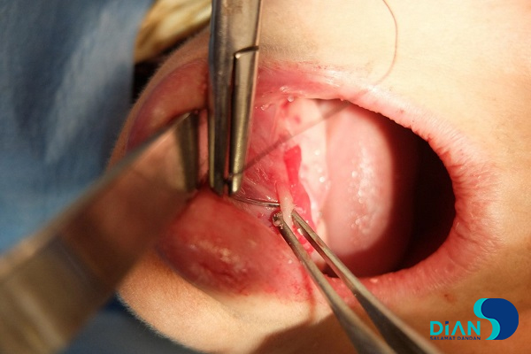 Immediate Implantation on the Lower Jaw