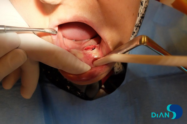 Immediate Implantation on the Lower Jaw