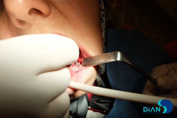 Immediate Implantation on the Lower Jaw