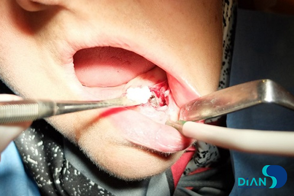 Immediate Implantation on the Lower Jaw