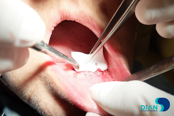 Immediate Implantation on the Lower Jaw