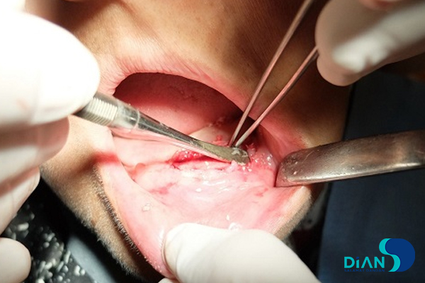 Immediate Implantation on the Lower Jaw