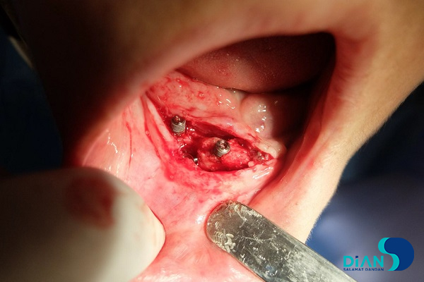 Immediate Implantation on the Lower Jaw