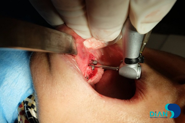 Immediate Implantation on the Lower Jaw