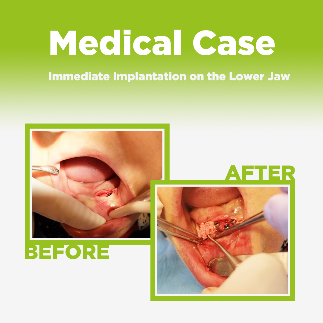 Immediate Implantation on the Lower Jaw