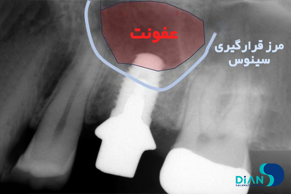قرار دادن ایمپلنت در موقعیت مناسب