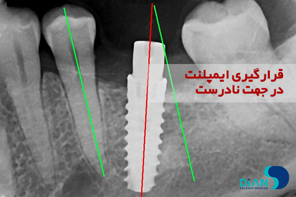 قرار دادن ایمپلنت در موقعیت مناسب