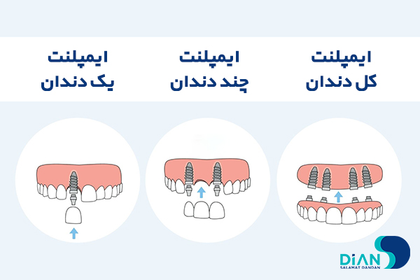 انتخاب پروتز دائمی
