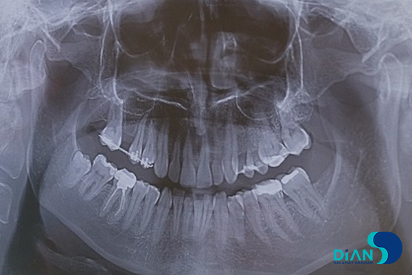 Implantation in Molar Area