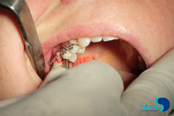 Implantation in Molar Area