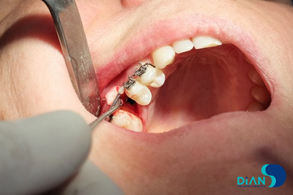 Implantation in Molar Area