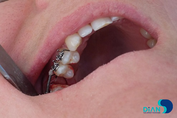 Implantation in Molar Area