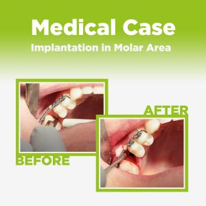 Implantation in Molar Area