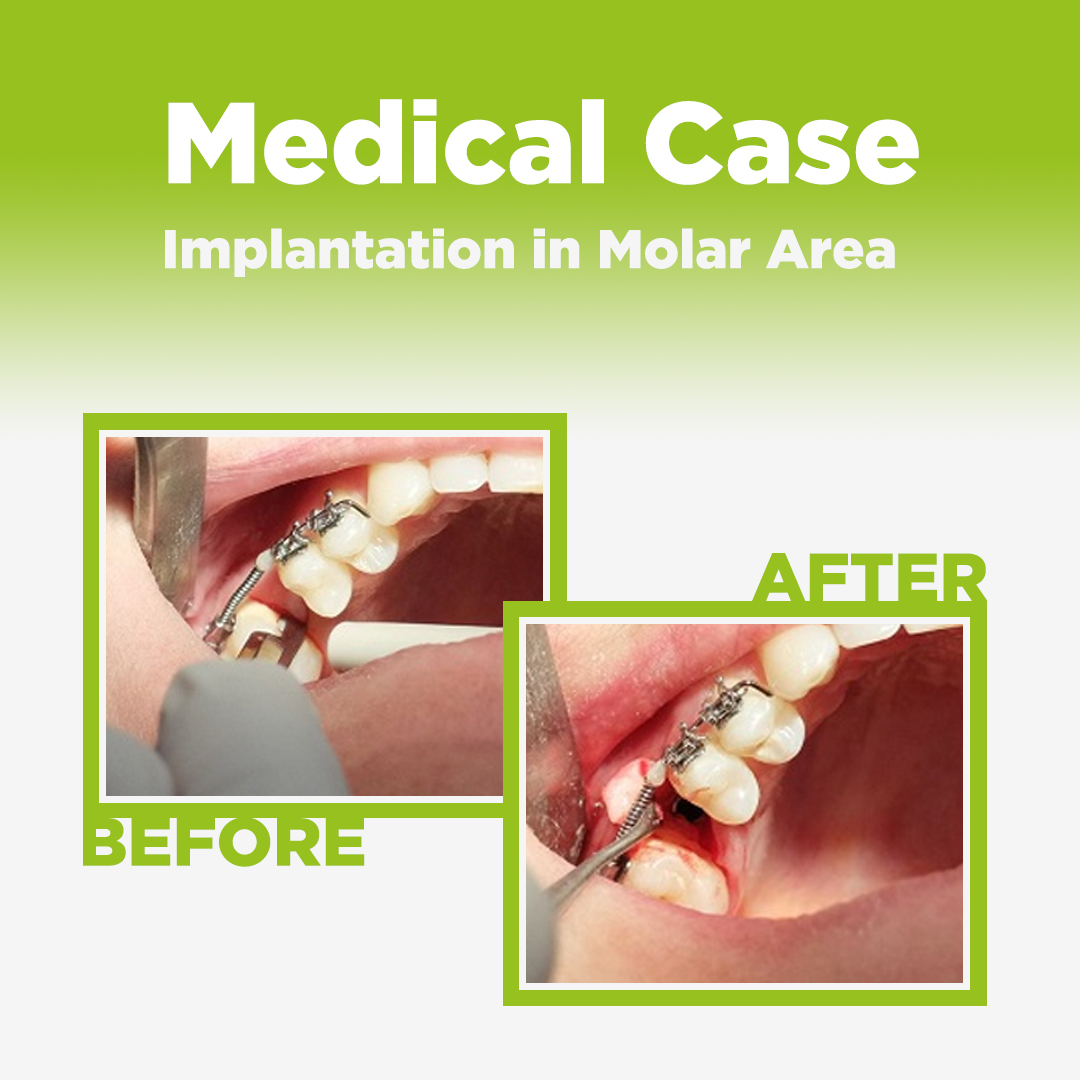 Implantation in Molar Area