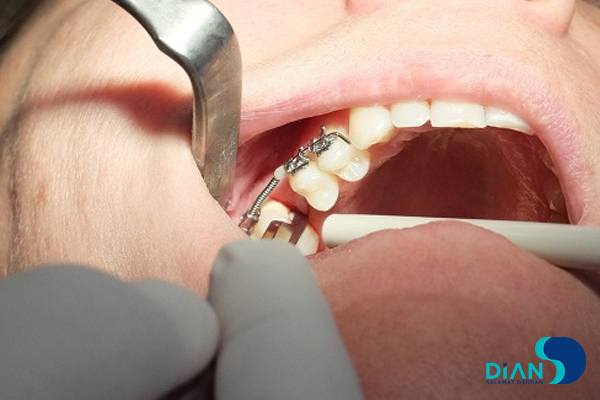 Implantation in Molar Area