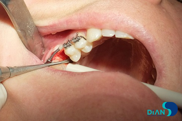 Implantation in Molar Area