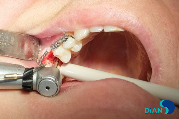 Implantation in Molar Area