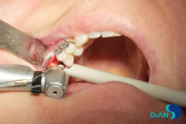 Implantation in Molar Area