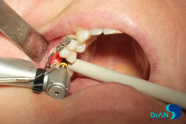 Implantation in Molar Area