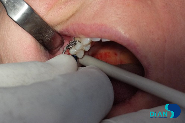 Implantation in Molar Area