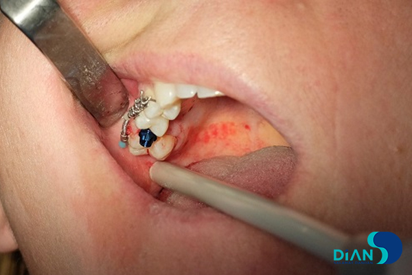 Implantation in Molar Area