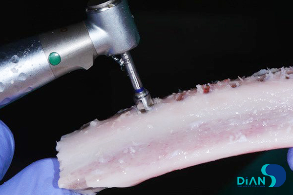 نقش سرعت دریلینگ در موفقیت ایمپلنت دندان