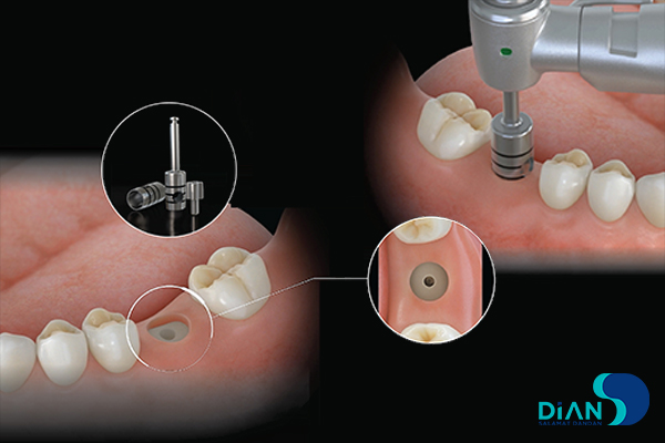 کاشت ایمپلنت به روش پانچ